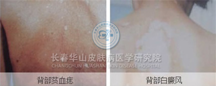 病图片 早期贫血斑图片贫血性白斑宝宝贫血痣图片贫血痣与贫血斑的